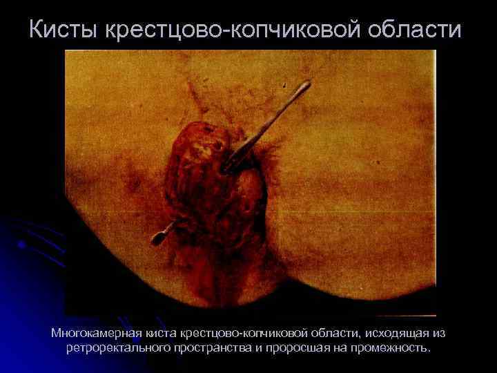 Кисты крестцово копчиковой области Многокамерная киста крестцово копчиковой области, исходящая из ретроректального пространства и