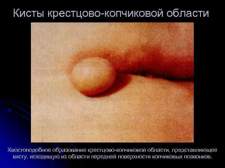 Кисты крестцово копчиковой области Хвостоподобное образование крестцово копчиковой области, представляющее кисту, исходящую из области