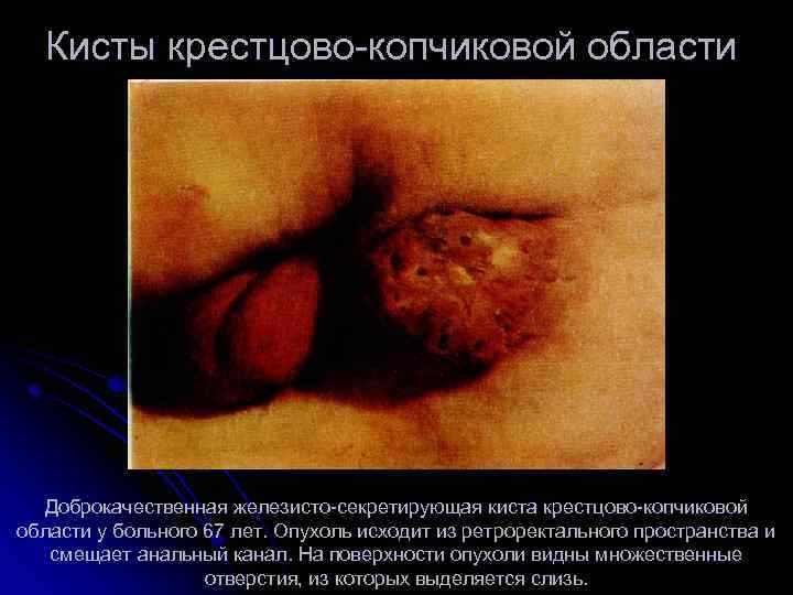 Кисты крестцово копчиковой области Доброкачественная железисто секретирующая киста крестцово копчиковой области у больного 67