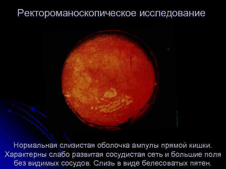 Ректороманоскопическое исследование Нормальная слизистая оболочка ампулы прямой кишки. Характерны слабо развитая сосудистая сеть и