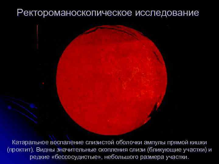 Ректороманоскопическое исследование Катаральное воспаление слизистой оболочки ампулы прямой кишки (проктит). Видны значительные скопления слизи