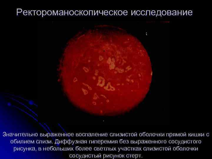 Ректороманоскопическое исследование Значительно выраженное воспаление слизистой оболочки прямой кишки с обилием слизи. Диффузная гиперемия