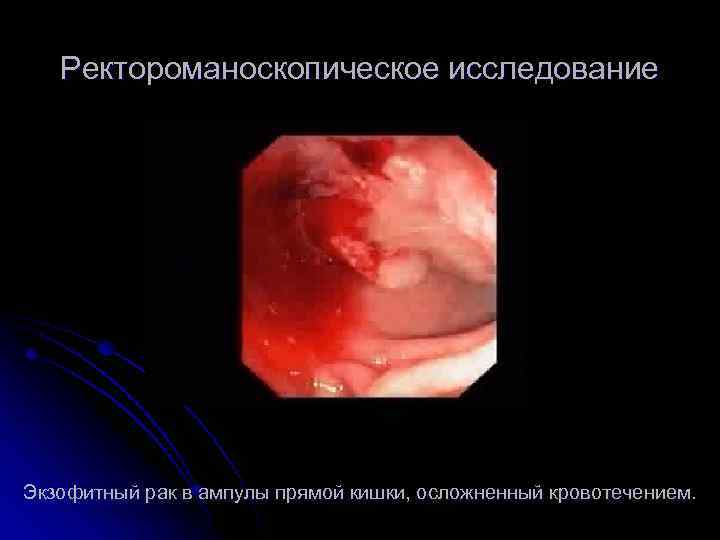 Ректороманоскопическое исследование Экзофитный рак в ампулы прямой кишки, осложненный кровотечением. 