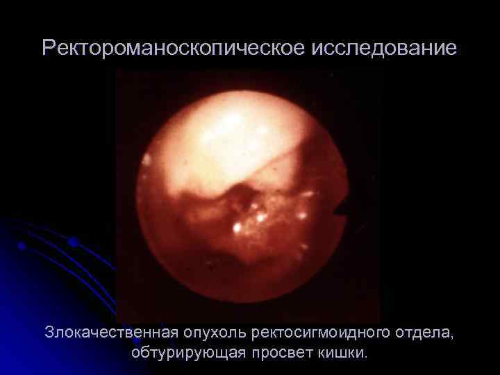 Ректороманоскопическое исследование Злокачественная опухоль ректосигмоидного отдела, обтурирующая просвет кишки. 