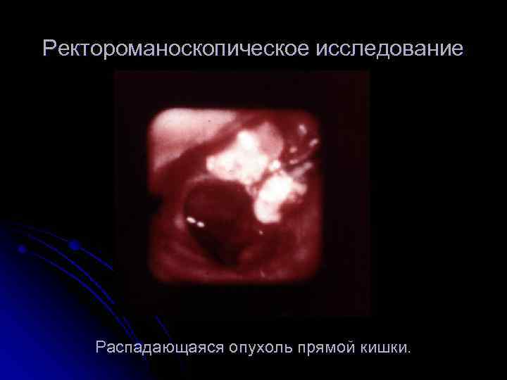 Ректороманоскопическое исследование Распадающаяся опухоль прямой кишки. 