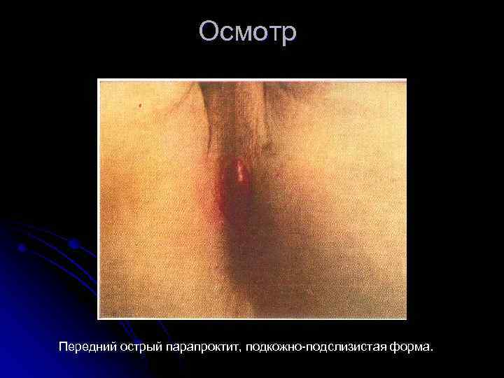 Осмотр Передний острый парапроктит, подкожно подслизистая форма. 