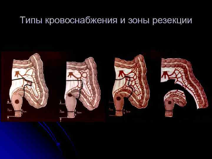 Типы кровоснабжения и зоны резекции 