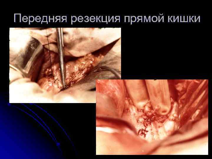 Передняя резекция прямой кишки 