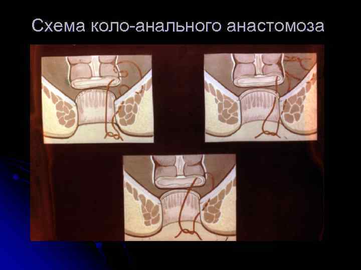 Схема коло анального анастомоза 