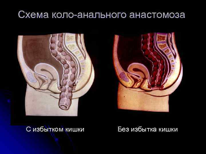 Схема коло анального анастомоза С избытком кишки Без избытка кишки 