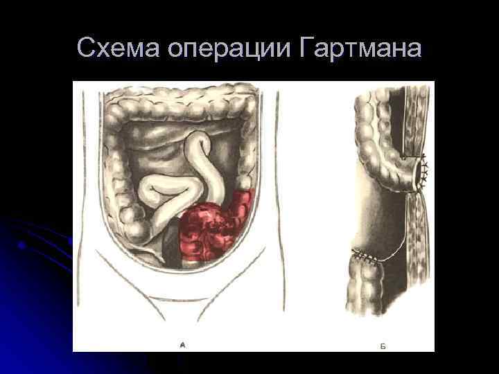 Схема операции Гартмана 