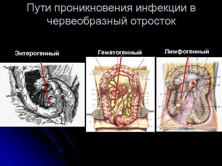 Пути проникновения инфекции в червеобразный отросток Энтерогенный Гематогенный Лимфогенный 