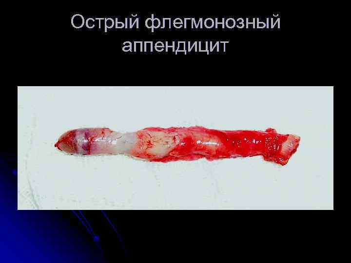 Острый флегмонозный аппендицит 