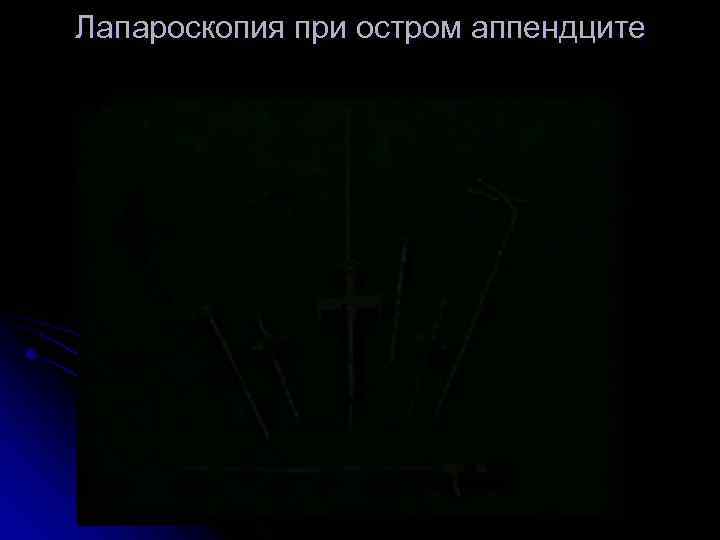 Лапароскопия при остром аппендците 