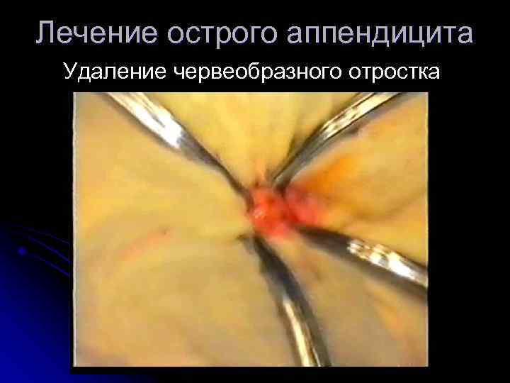 Лечение острого аппендицита Удаление червеобразного отростка 