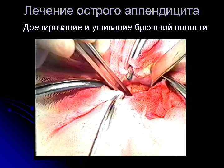 Лечение острого аппендицита Дренирование и ушивание брюшной полости 