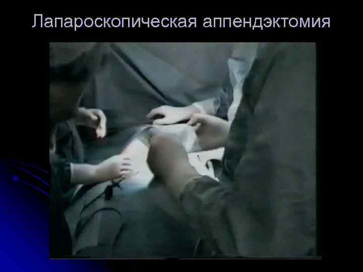 Лапароскопическая аппендэктомия 