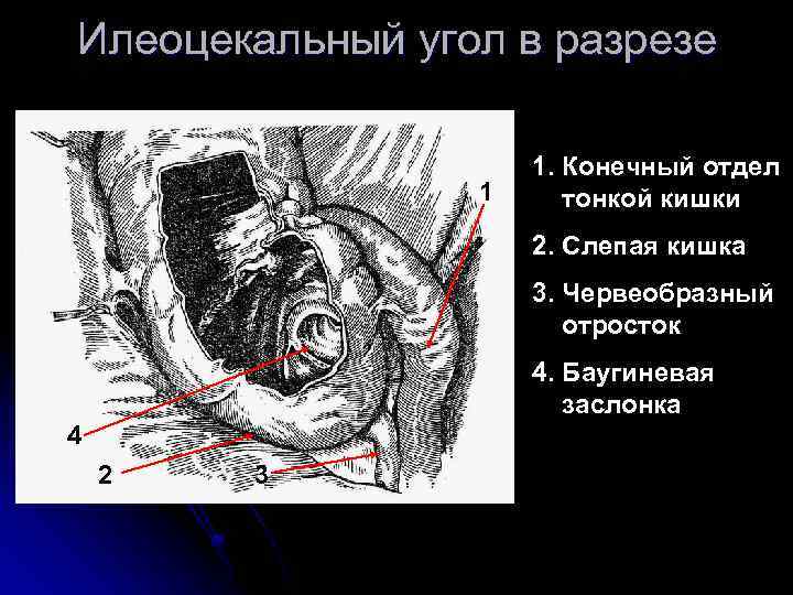Илеоцекальный угол в разрезе 1 1. Конечный отдел тонкой кишки 2. Слепая кишка 3.