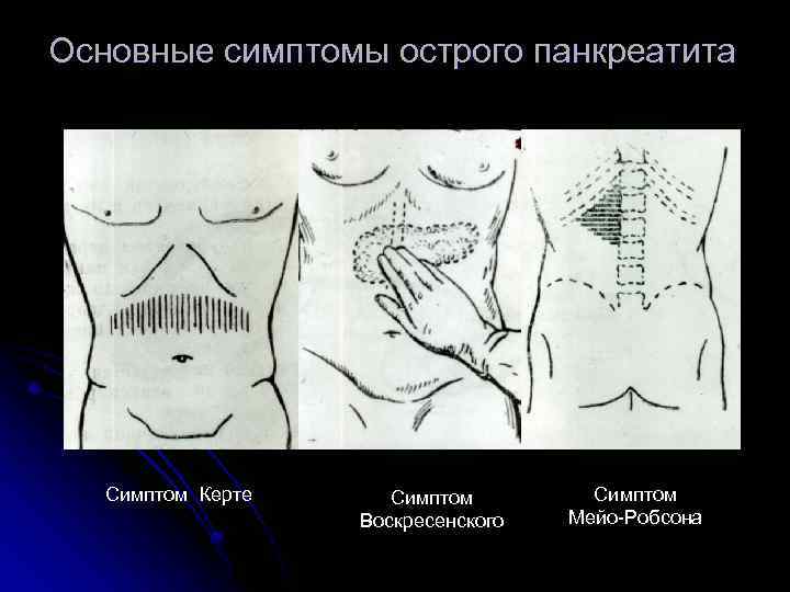 Основные симптомы острого панкреатита Симптом Керте Симптом Воскресенского Симптом Мейо-Робсона 