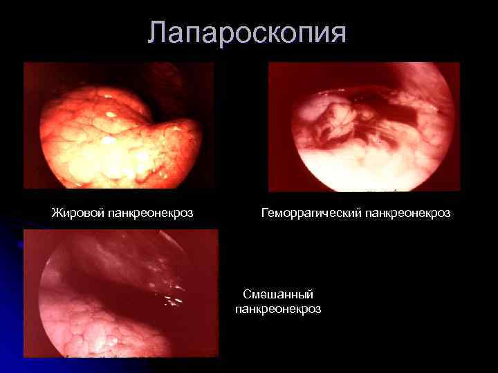 Стол 5 при остром панкреатите