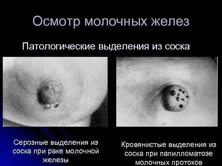 Осмотр молочных желез Патологические выделения из соска Серозные выделения из соска при раке молочной