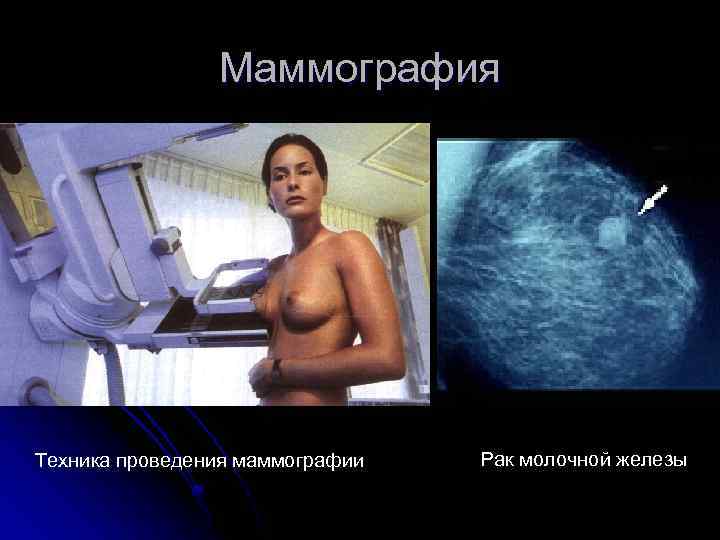 Маммография Техника проведения маммографии Рак молочной железы 