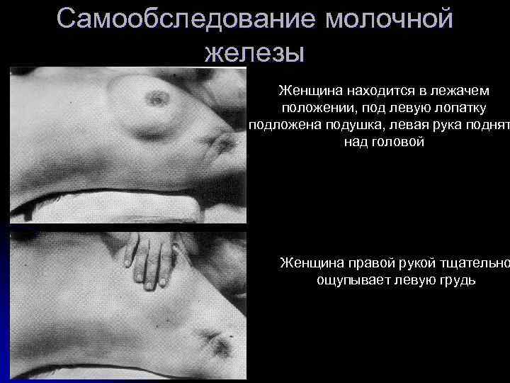Самообследование молочной железы Женщина находится в лежачем положении, под левую лопатку подложена подушка, левая