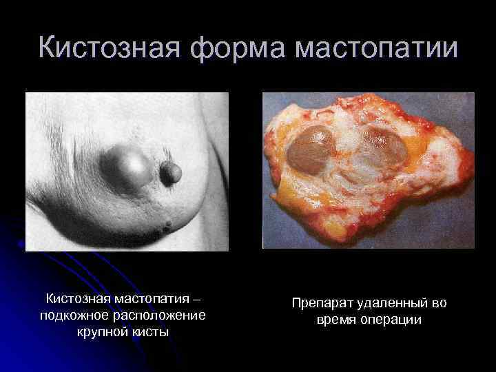 Кистозная форма мастопатии Кистозная мастопатия – подкожное расположение крупной кисты Препарат удаленный во время