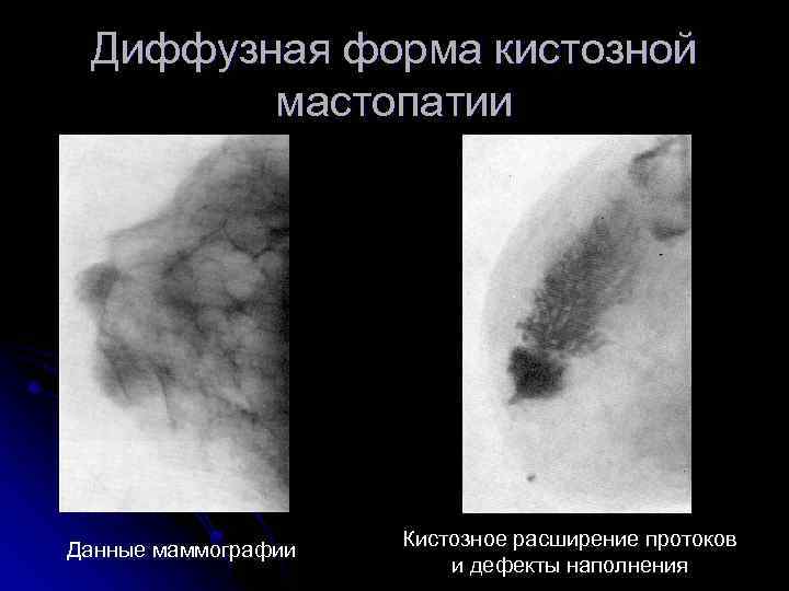 Диффузная форма кистозной мастопатии Данные маммографии Кистозное расширение протоков и дефекты наполнения 