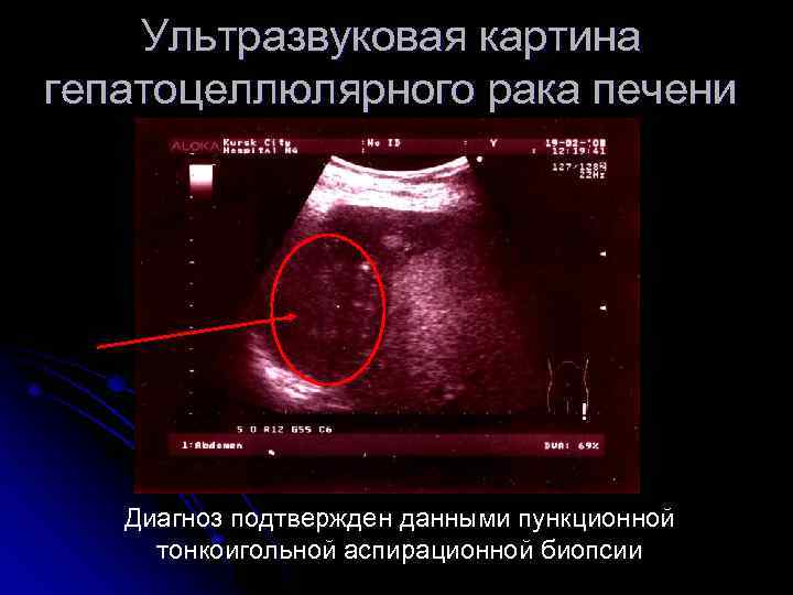 Ультразвуковая картина гепатоцеллюлярного рака печени Диагноз подтвержден данными пункционной тонкоигольной аспирационной биопсии 