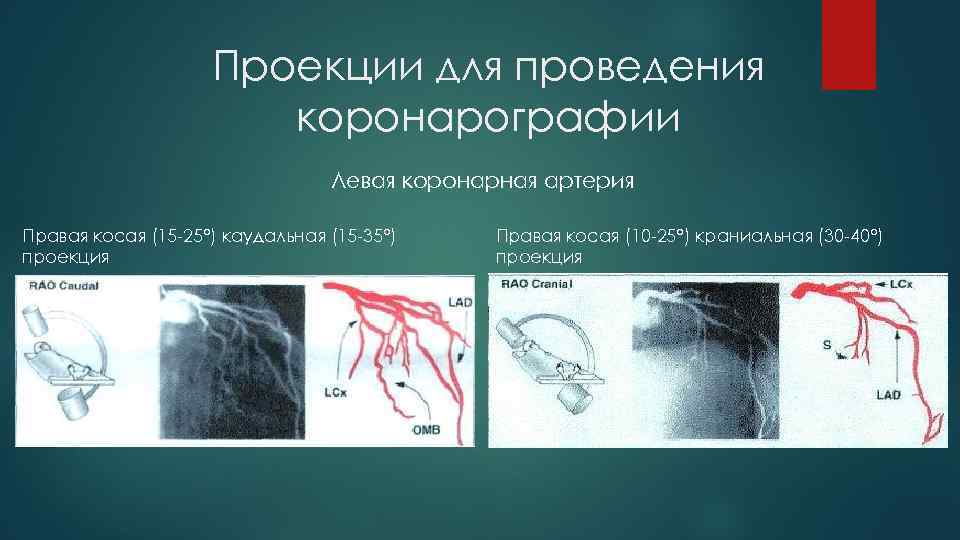 Проекции для проведения коронарографии Левая коронарная артерия Правая косая (15 -25°) каудальная (15 -35°)