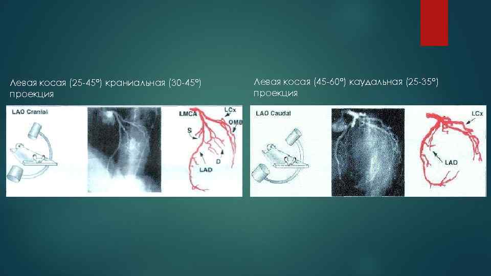 Левая косая (25 -45°) краниальная (30 -45°) проекция Левая косая (45 -60°) каудальная (25