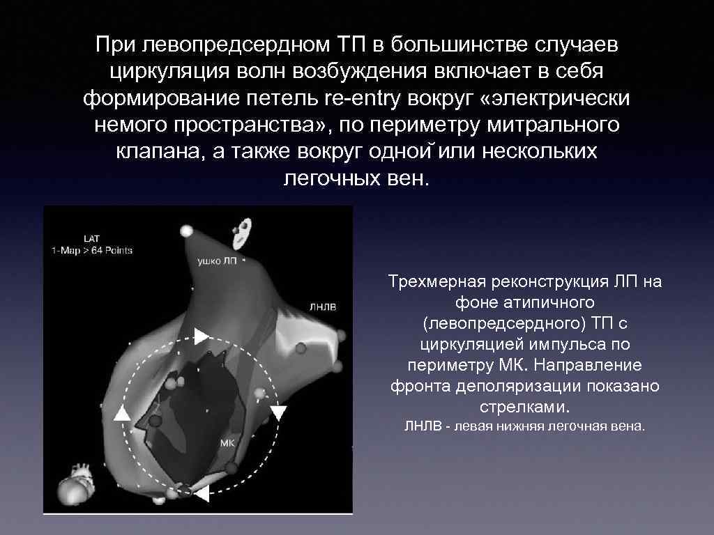 При левопредсердном ТП в большинстве случаев циркуляция волн возбуждения включает в себя формирование петель