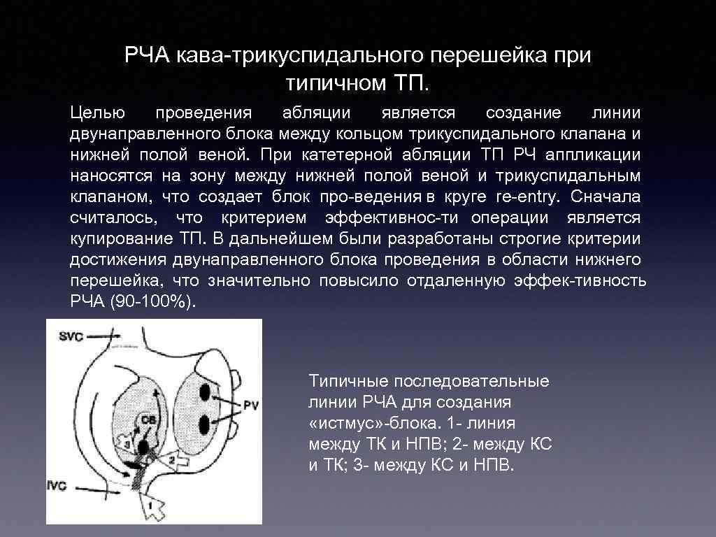 Пульс после рча. РЧА каватрикуспидальный истмус. Радиочастотная абляция кава трикуспидального перешейка. Каво трикуспидальный перешеек.