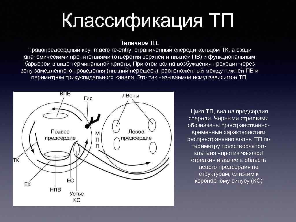 Классификация ТП Типичное ТП. Правопредсердный круг macro re entry, ограниченный спереди кольцом ТК, а