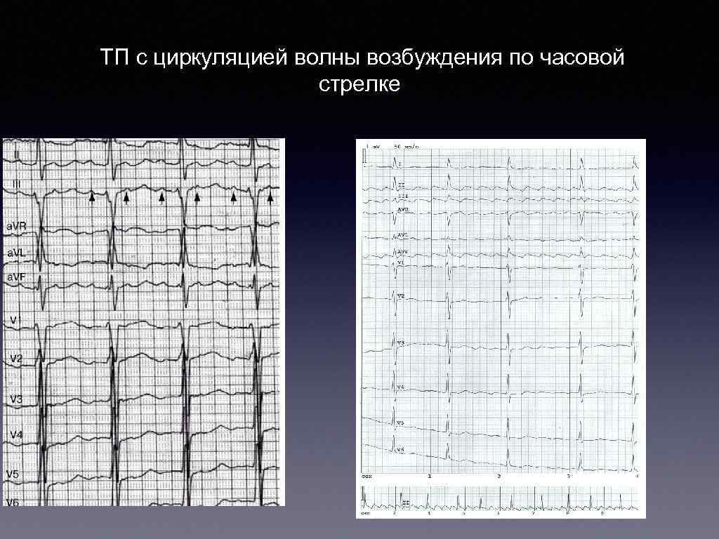 ТП с циркуляцией волны возбуждения по часовой стрелке 