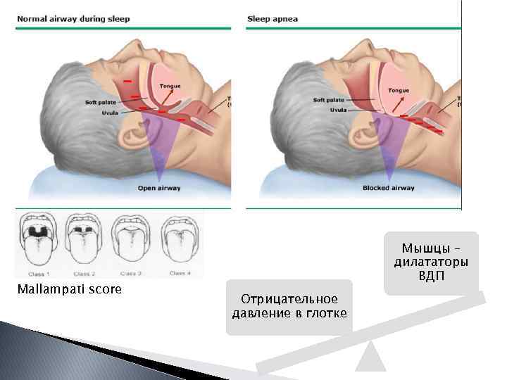 Mallampati score Мышцы – дилататоры ВДП Отрицательное давление в глотке 