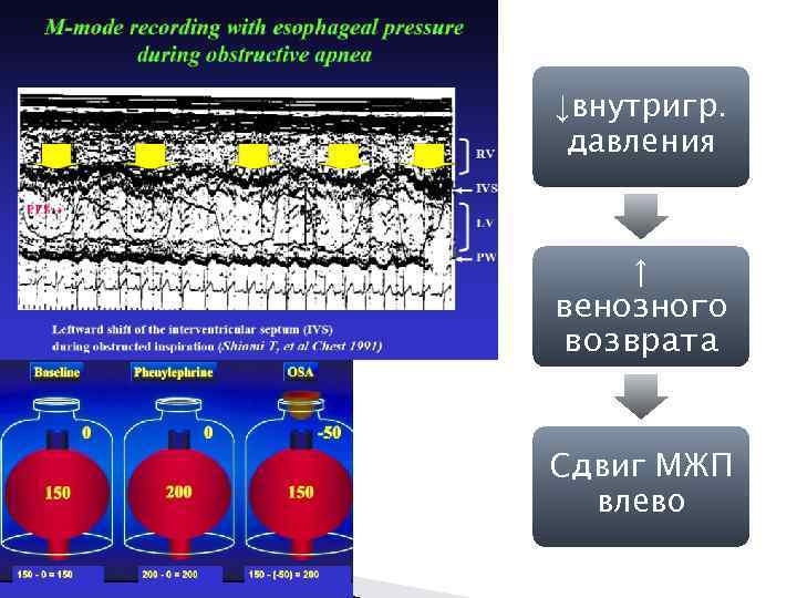 ↓внутригр. давления ↑ венозного возврата Сдвиг МЖП влево 