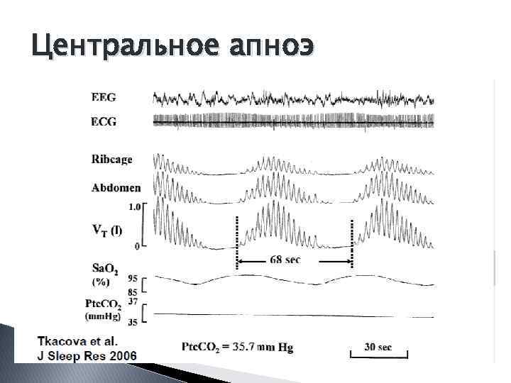 Центральное апноэ 