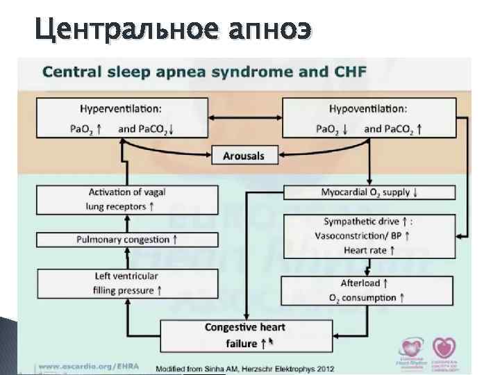 Центральное апноэ 