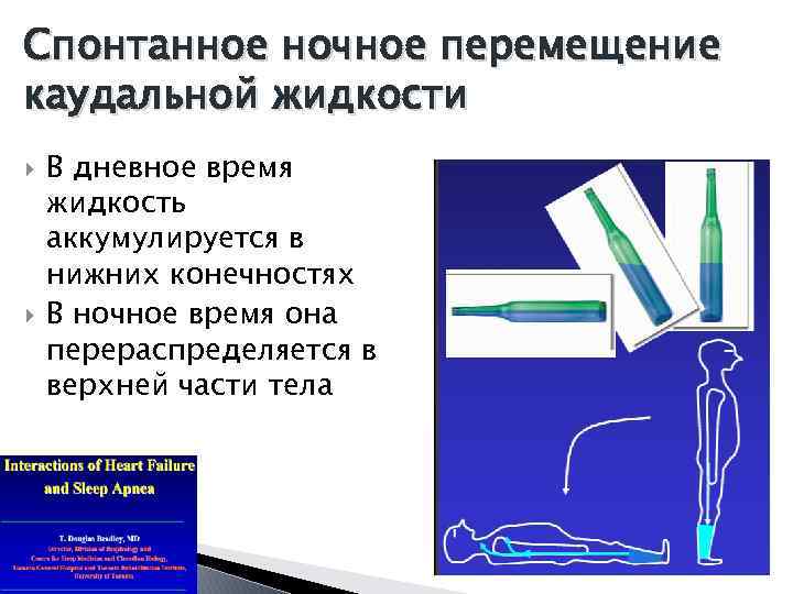 Спонтанное ночное перемещение каудальной жидкости В дневное время жидкость аккумулируется в нижних конечностях В