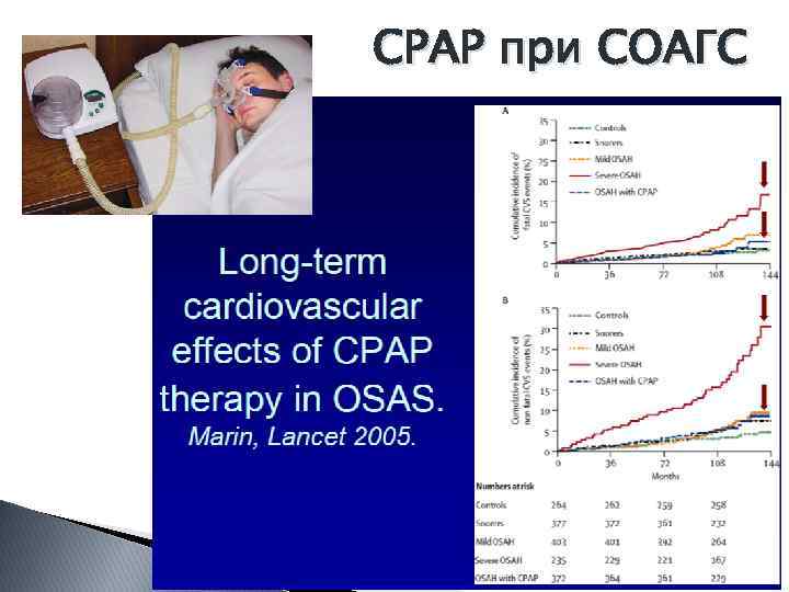 CPAP при СОАГС 