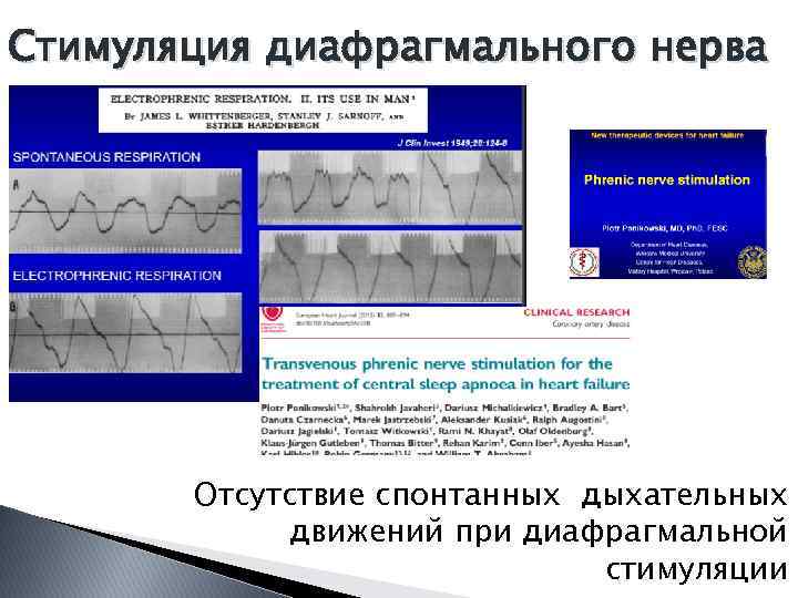 Стимуляция диафрагмального нерва Отсутствие спонтанных дыхательных движений при диафрагмальной стимуляции 