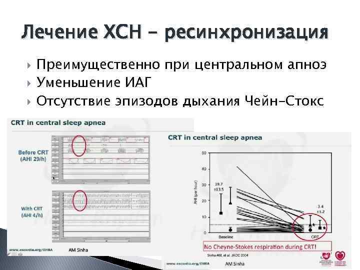 Лечение ХСН - ресинхронизация Преимущественно при центральном апноэ Уменьшение ИАГ Отсутствие эпизодов дыхания Чейн-Стокс