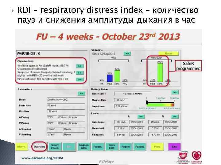  RDI – respiratory distress index – количество пауз и снижения амплитуды дыхания в