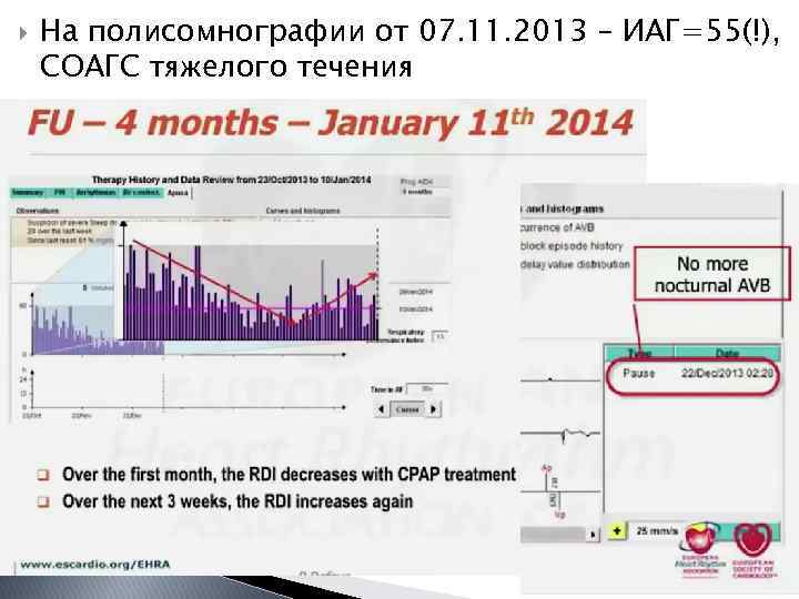  На полисомнографии от 07. 11. 2013 – ИАГ=55(!), СОАГС тяжелого течения 