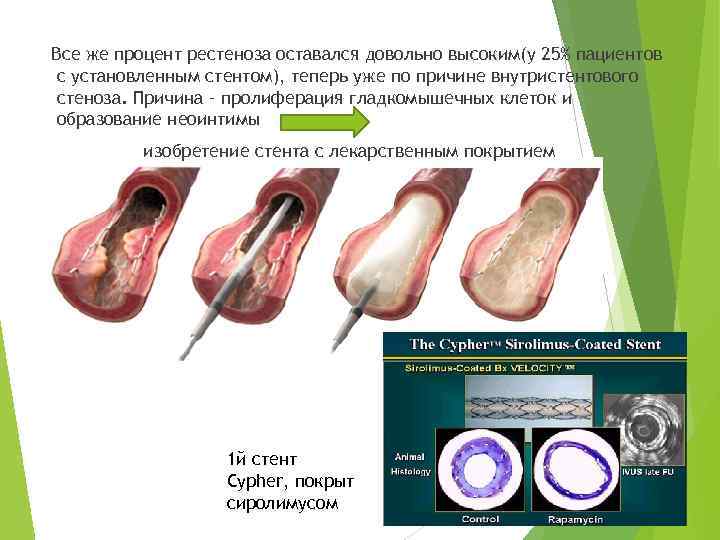 Все же процент рестеноза оставался довольно высоким(у 25% пациентов с установленным стентом), теперь уже