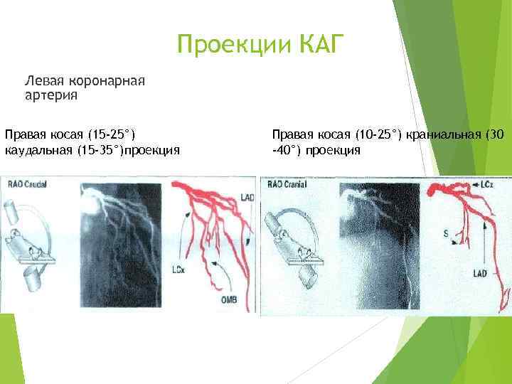 Проекции КАГ Левая коронарная артерия Правая косая (15 -25°) каудальная (15 -35°)проекция Правая косая