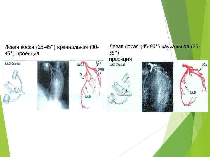 Левая косая (25 -45°) краниальная (3045°) проекция Левая косая (45 -60°) каудальная (2535°) проекция