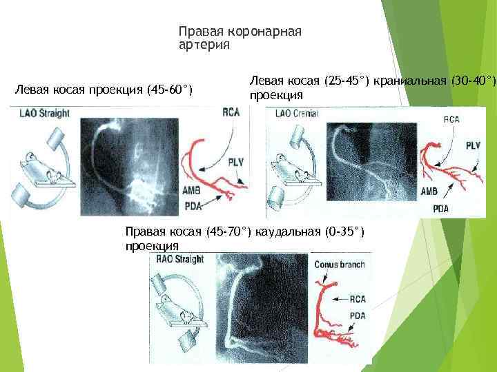 Правая коронарная артерия Левая косая проекция (45 -60°) Левая косая (25 -45°) краниальная (30